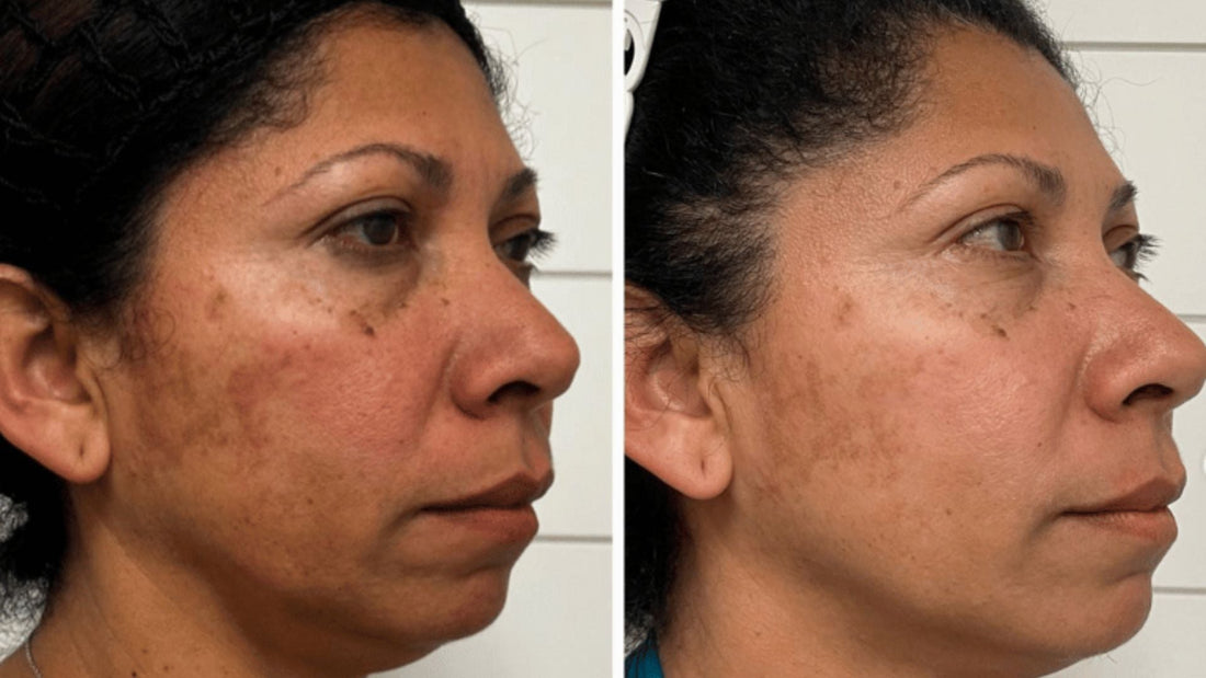 NeoGen Plasma Skin Regeneration: The Science Behind Nitrogen Plasma Resurfacing Skinfluence Blog | Chicago Cosmetic Surgery & Dermatology