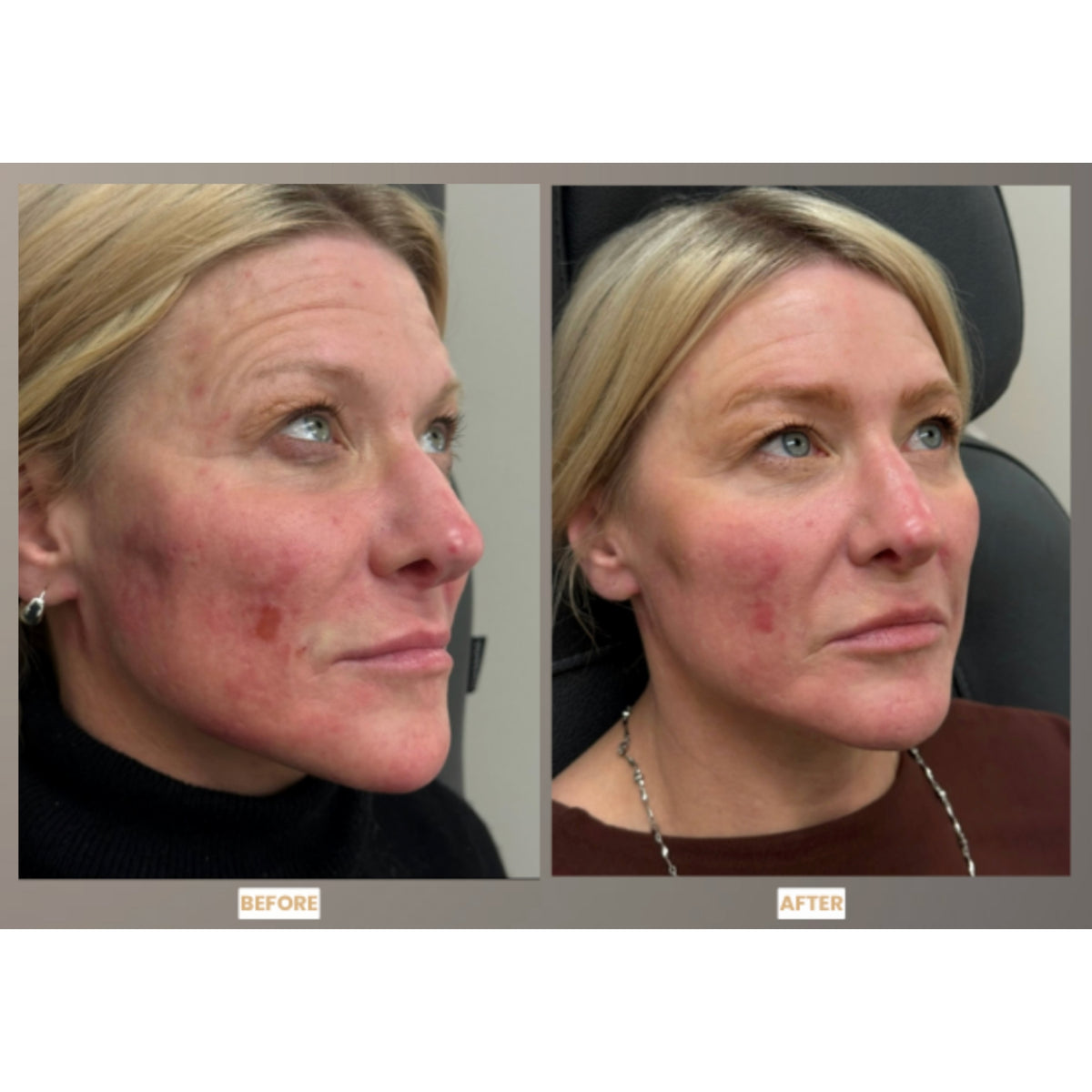 $25 Off NEW CO2Lift® R4 Renewal Facial & Hand Renew Treatment