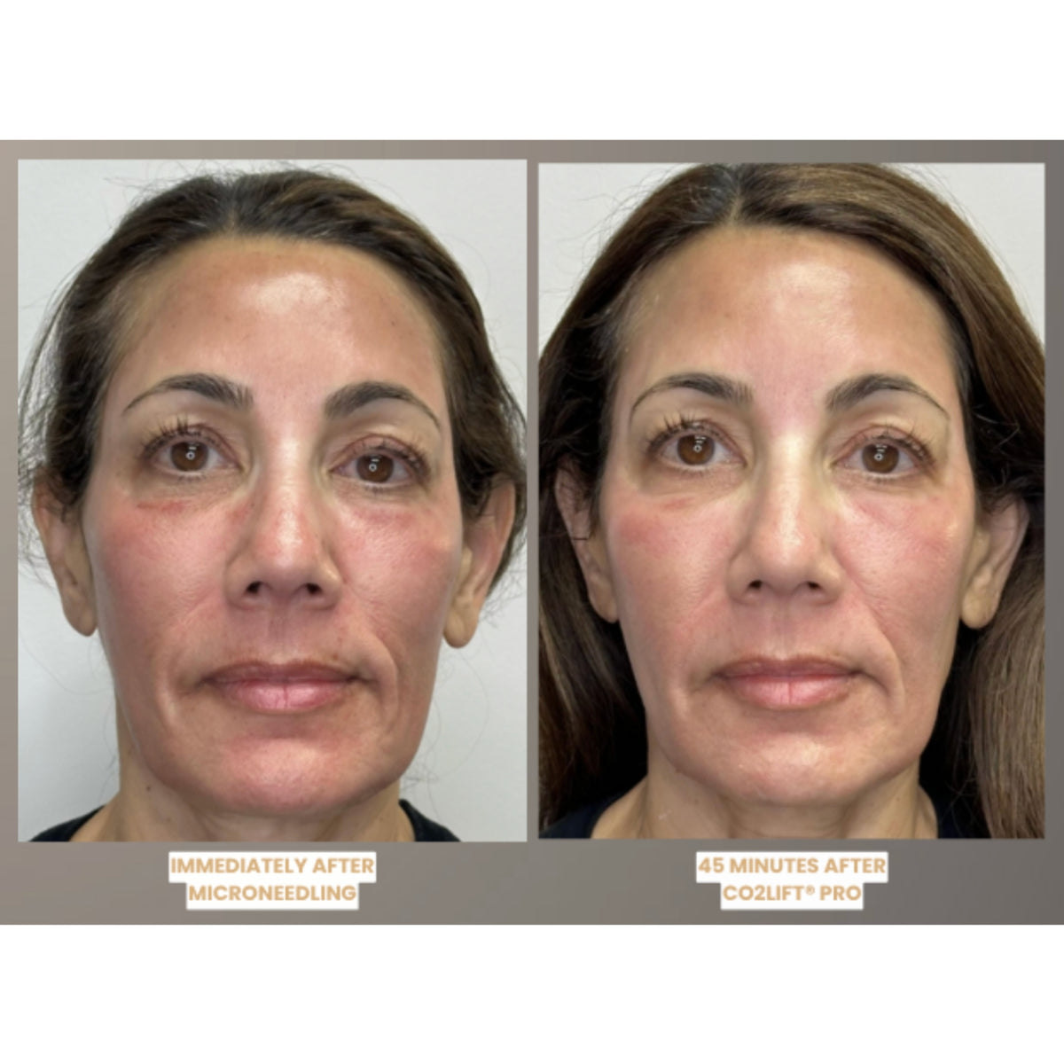 $25 Off NEW CO2Lift® R4 Renewal Facial & Hand Renew Treatment