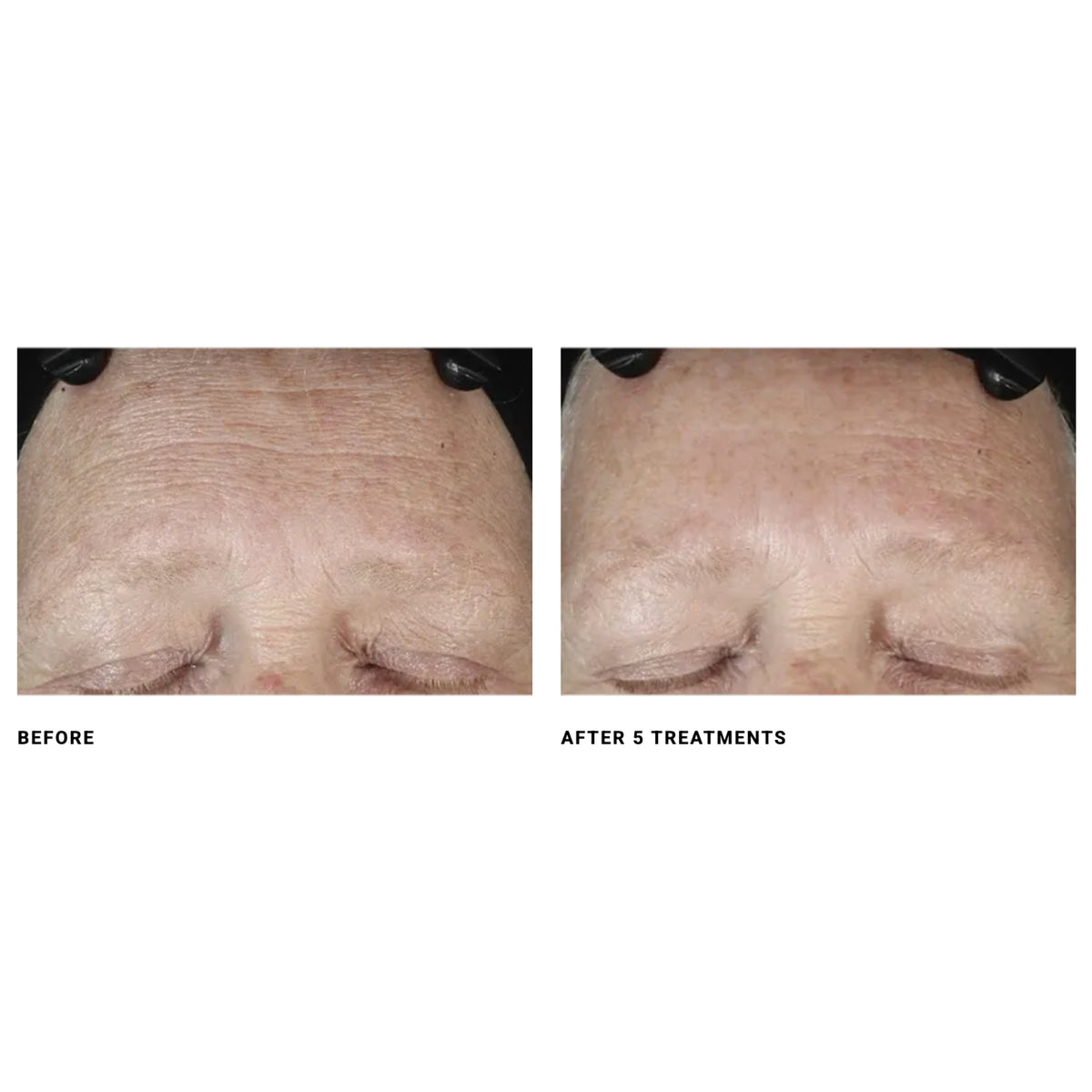 $200 Off DiamondGlow® Microdermabrasion – Package of (6)
