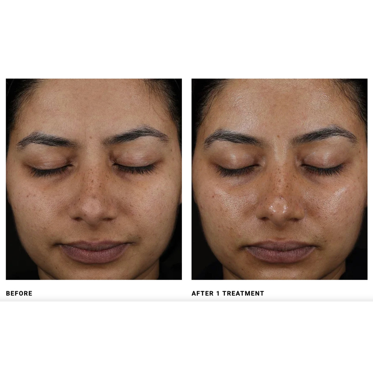 $200 Off DiamondGlow® Microdermabrasion – Package of (6)