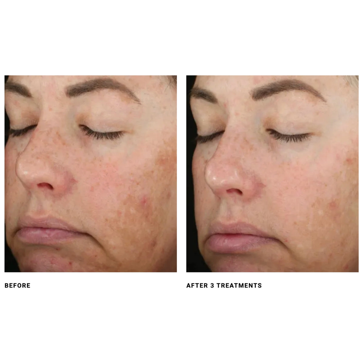 $200 Off DiamondGlow® Microdermabrasion – Package of (6)