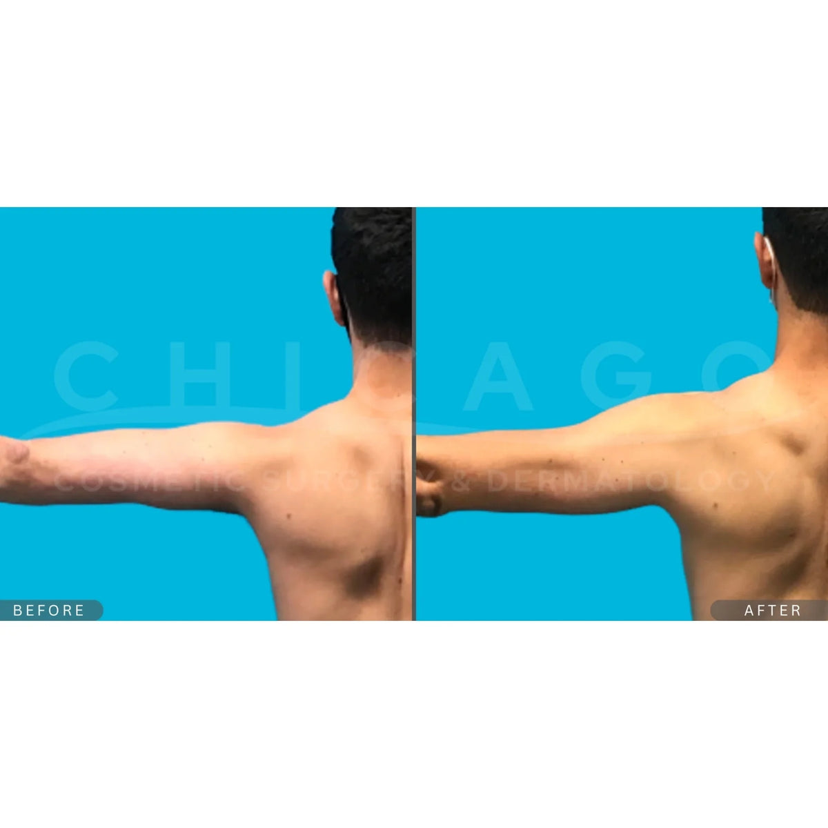 $1,000 Off EMSCULPT NEO® – Package of (4)