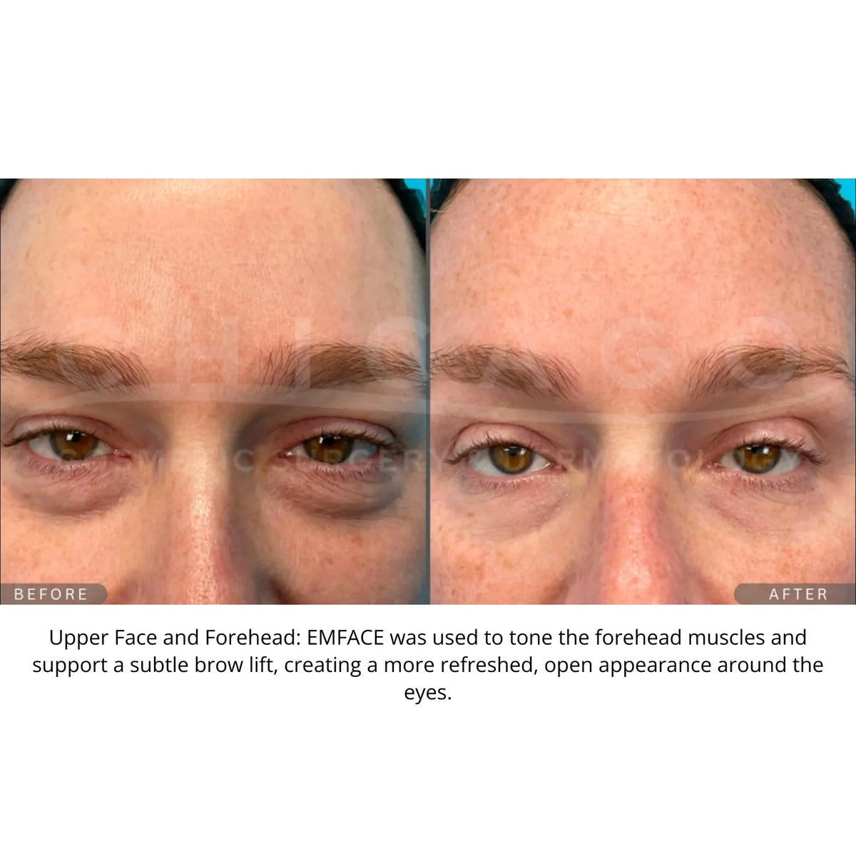 $1,000 Off EMFACE® – Package of (4)