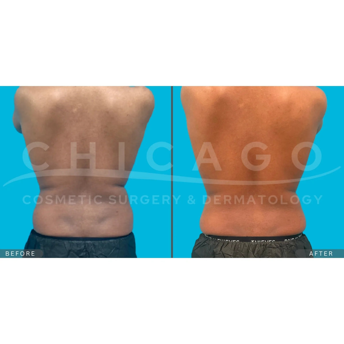 $1,000 Off EMSCULPT NEO® – Package of (4)