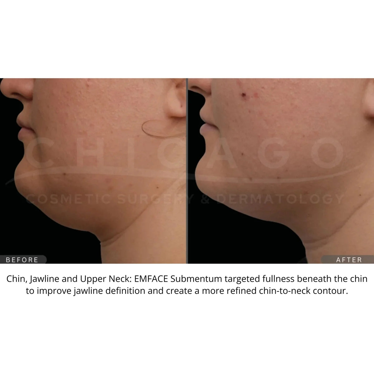 $1,000 Off EMFACE® – Package of (4)