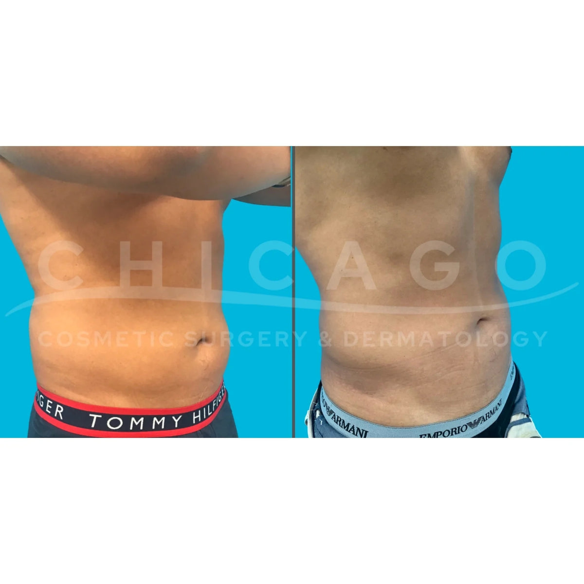 $1,000 Off EMSCULPT NEO® – Package of (4)
