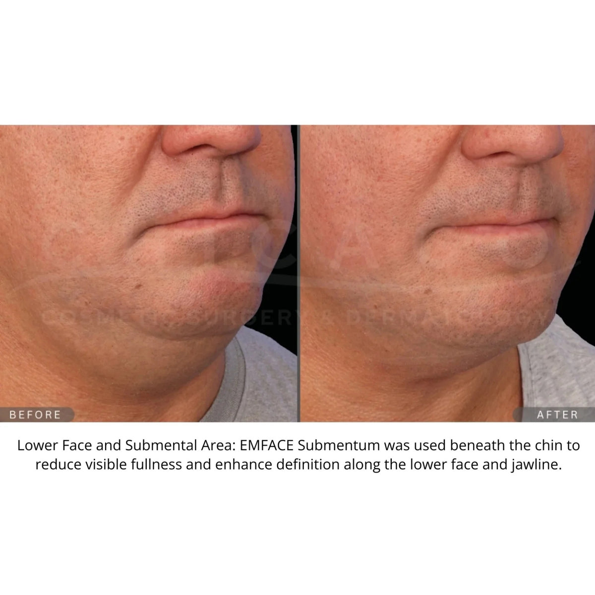 $1,000 Off EMFACE® – Package of (4)