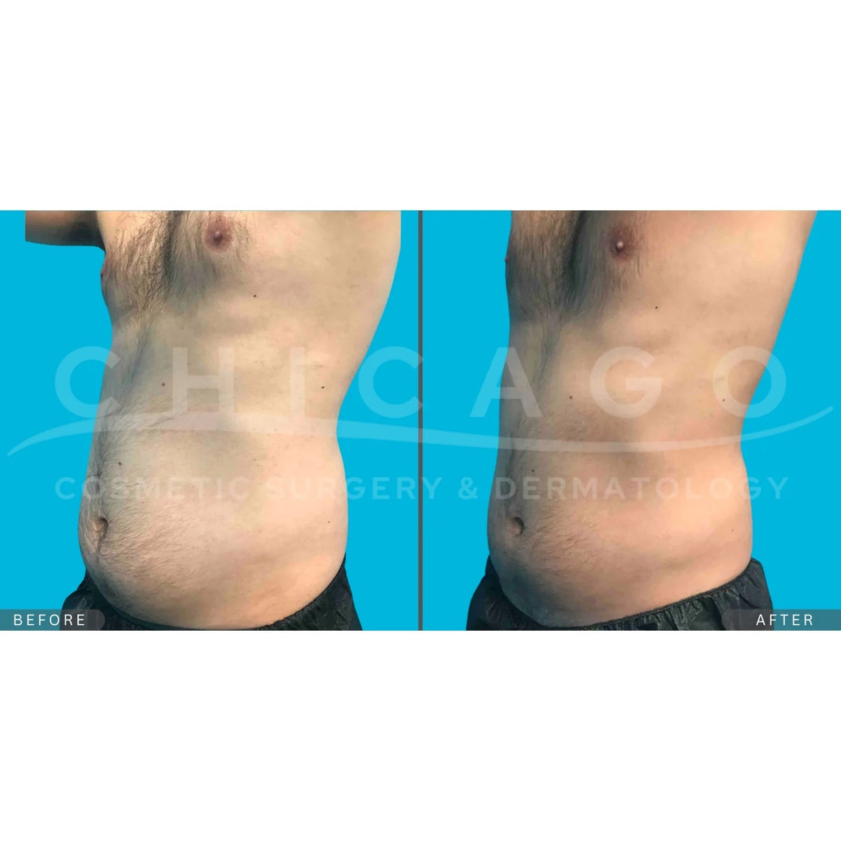$1,000 Off EMSCULPT NEO® – Package of (4)