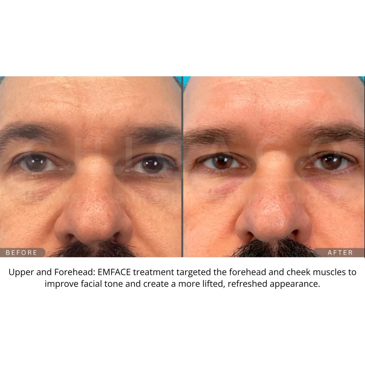 $1,000 Off EMFACE® – Package of (4)