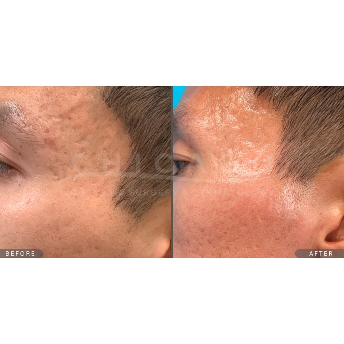 $300 Off INVO Microneedling (Package of 3)