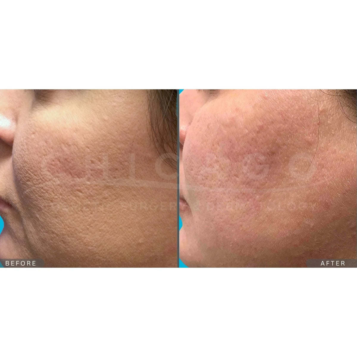 $300 Off INVO Microneedling (Package of 3)