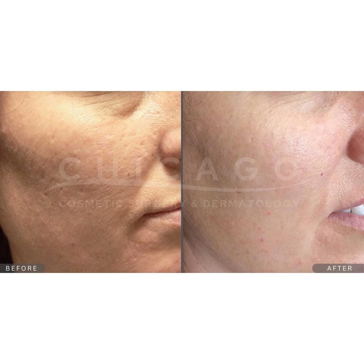 $300 Off INVO Microneedling (Package of 3)