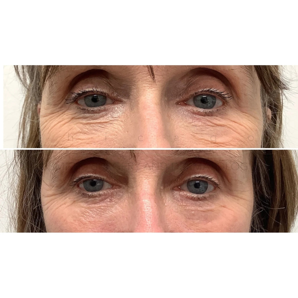 $500 Off Thermage® FLX – Full Face & Neck
