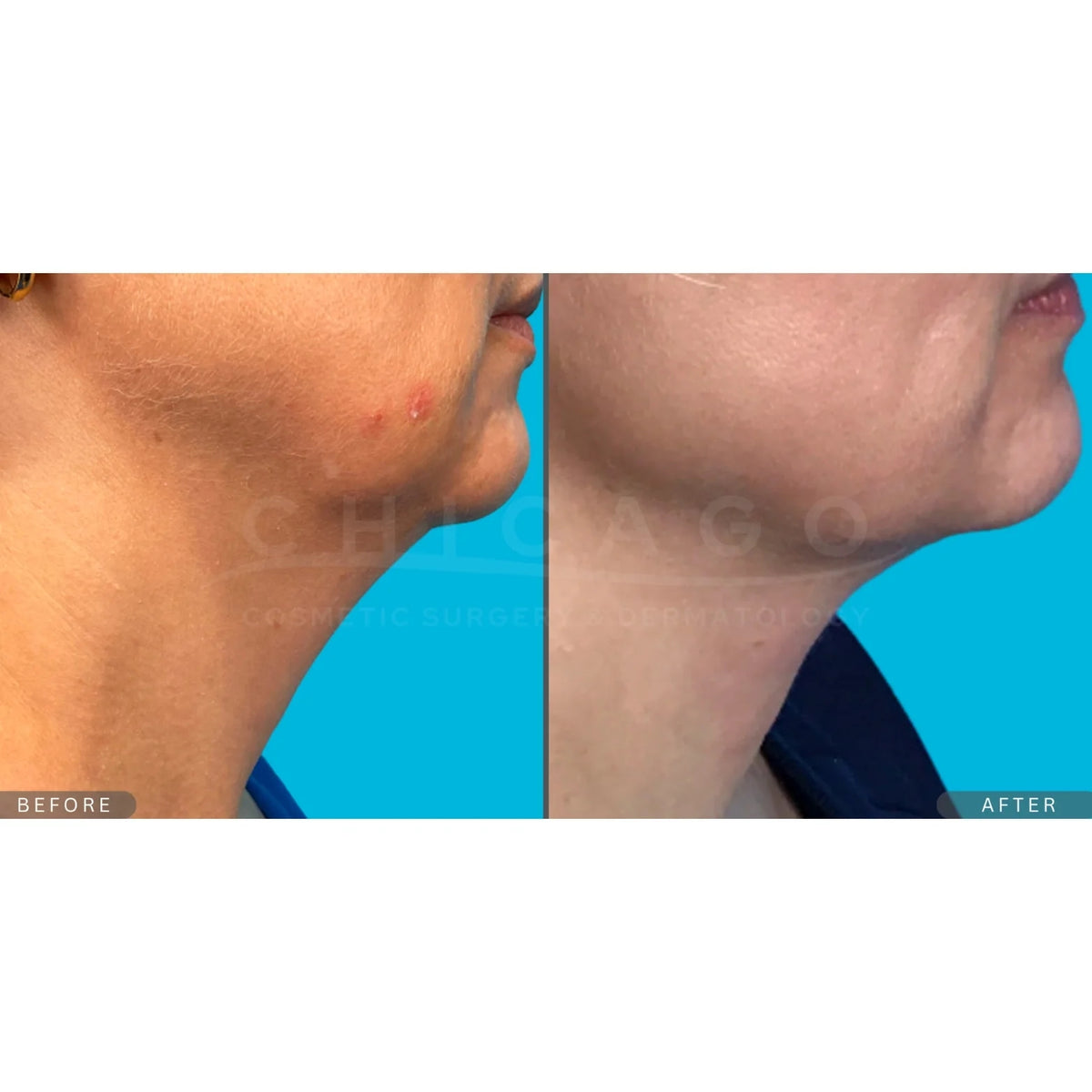$500 Off Thermage® FLX – Full Face & Neck