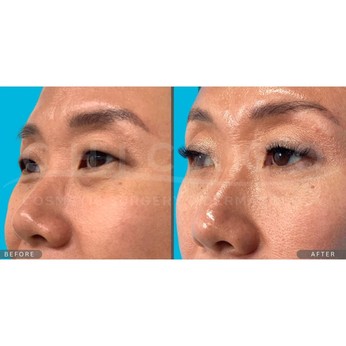 $500 Off Thermage® FLX – Full Face & Neck
