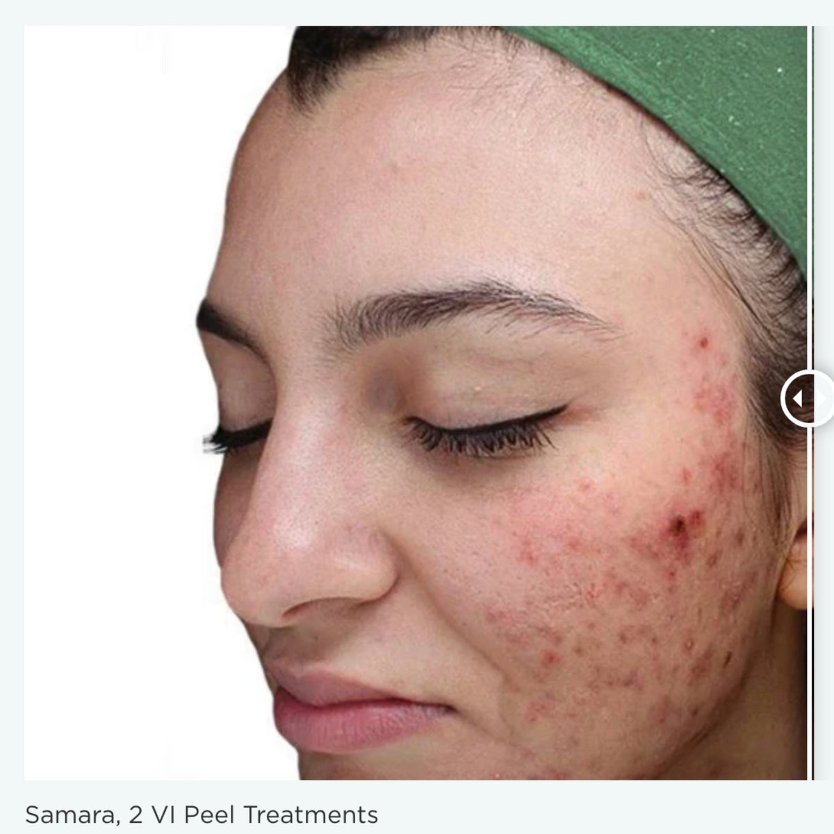 $200 Off VI Peel® – Face and Neck, Package of (3)