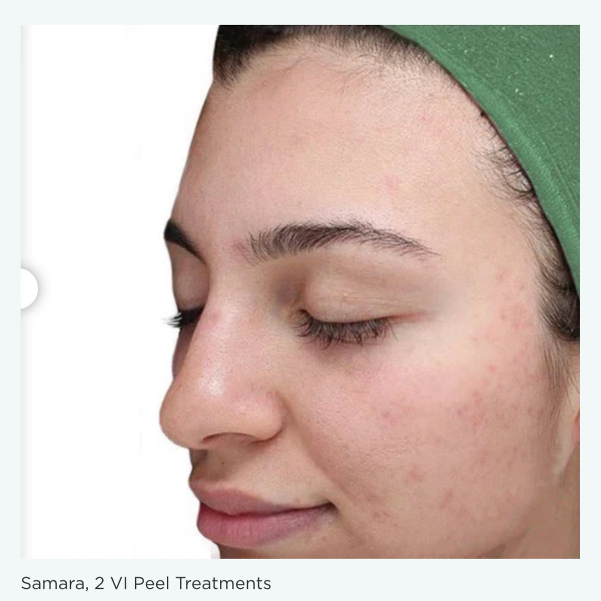 $200 Off VI Peel® – Face and Neck, Package of (3)