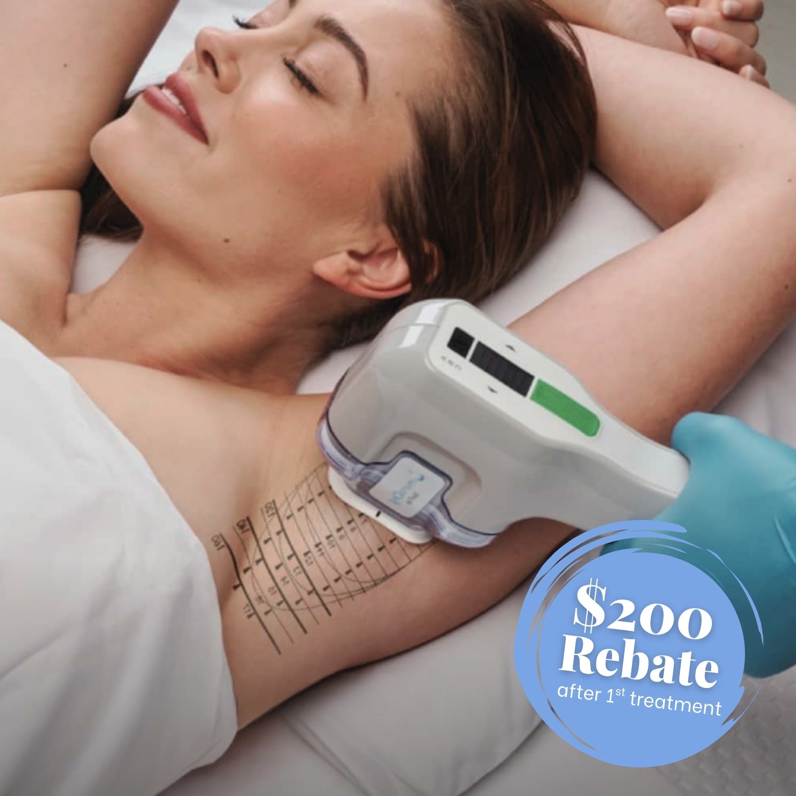 miraDry® Sweat Reduction Package + $200 Rebate